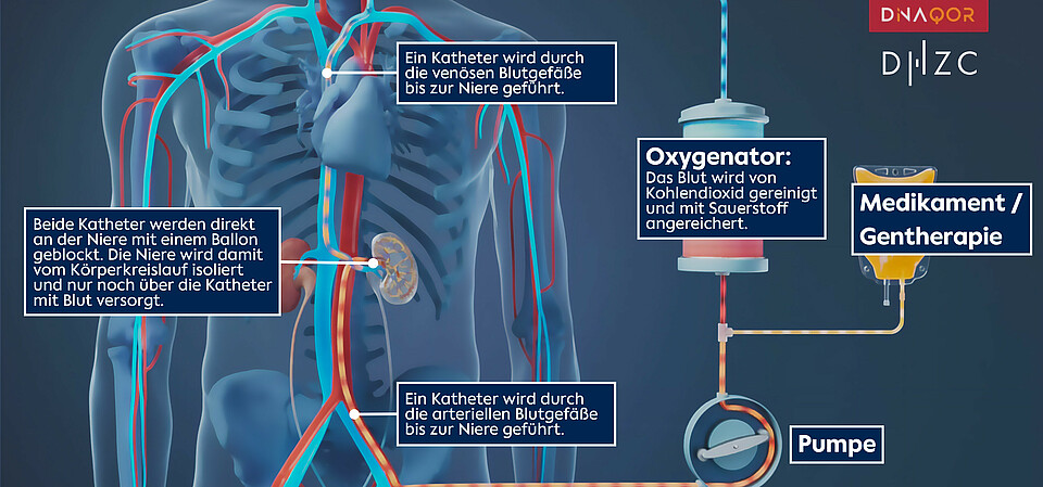 Illustration of the catheter-based “closed-loop perfusion system”